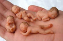 Редукция эмбрионов при многоплодной беременности