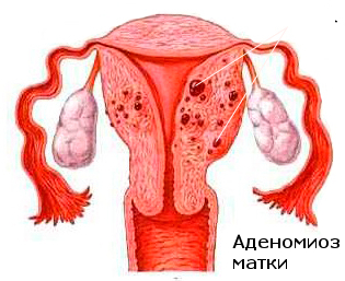 Аденомиоз и эндомеетриоз в чем разница