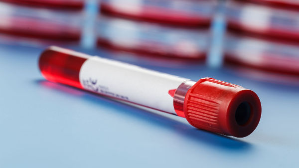 Діагностика антифосфоліпідного синдрому при вагітності 