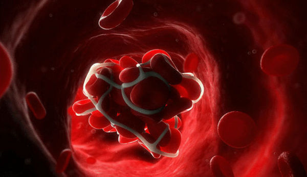 заважає антифосфоліпідний синдром завагітніти 