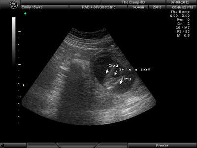 Мальчик на УЗИ в 15 недель беременности