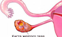 Киста желтого тела лечение