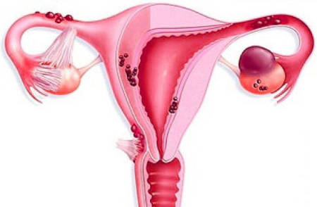 Эндометриоидная киста яичника и беременность