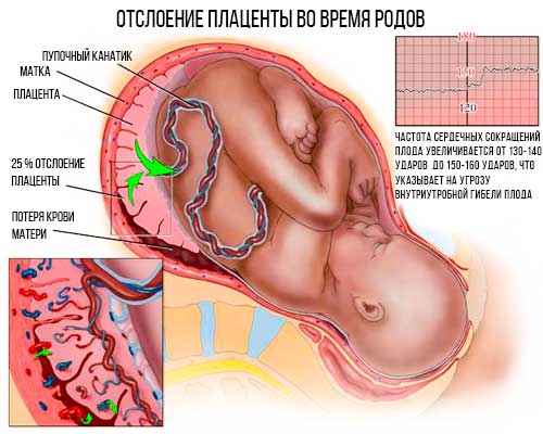 Отслойка плаценты при родах
