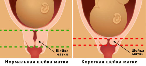 Норма длины шейки матки при беременности
