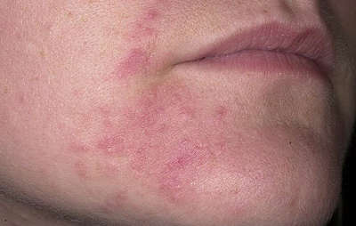 Аллергия на коже лица 
