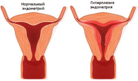 Что такое гиперплазия эндометрия