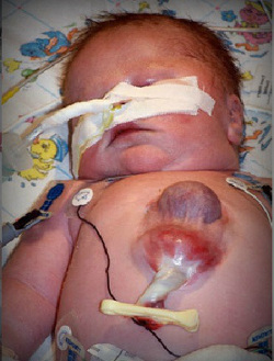 Эктопия сердца у новорожденного фото