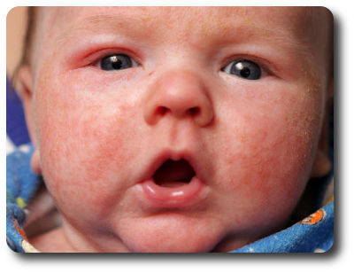 Атопический дерматит у грудничков фото на лице