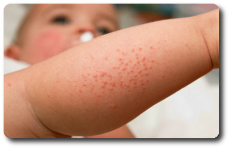 Аллергические элементы на коже малыша
