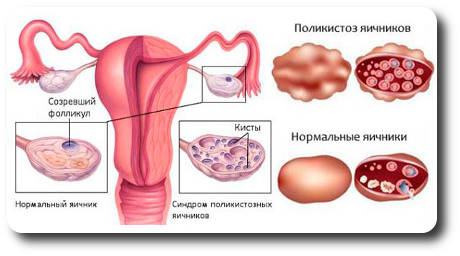 Нормальные яичники и яичники при поликистозе
